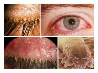 příznaky přítomnosti parazitů pod lidskou kůží